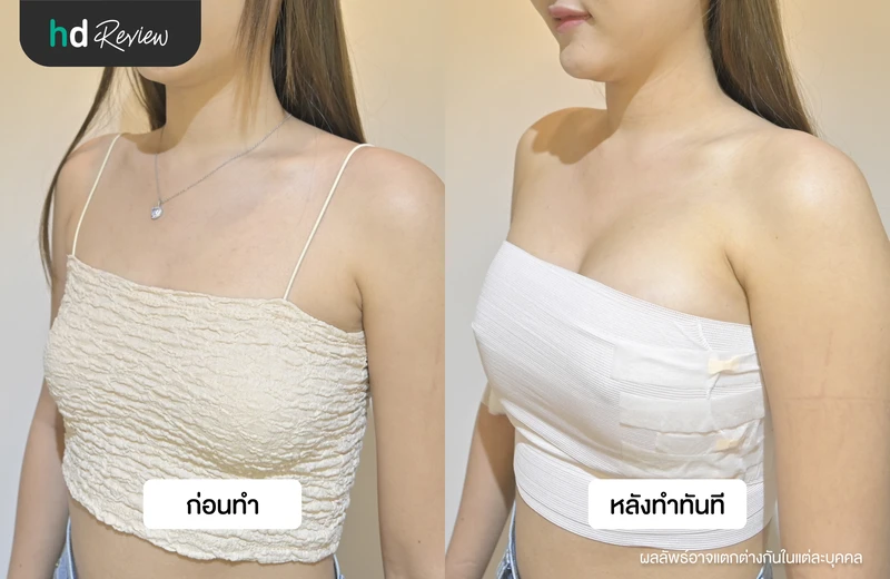 ภาพเปรียบเทียบก่อนและหลังเสริมหน้าอกทันที