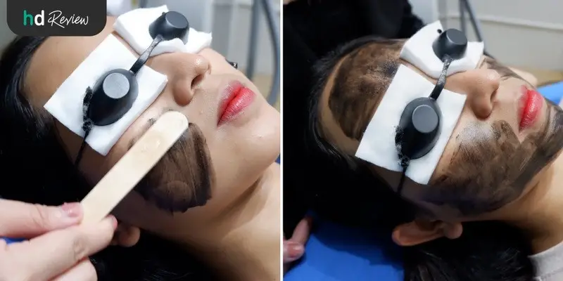 รีวิว Carbon Peel Laser ฟื้นฟูผิว กระชับรูขุมขน ฝ้ากระ ที่ Divine Aesthetic Clinic