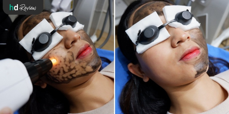 รีวิว Carbon Peel Laser ฟื้นฟูผิว กระชับรูขุมขน ฝ้ากระ ที่ Divine Aesthetic Clinic