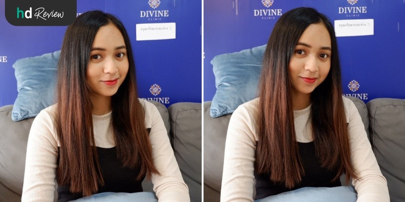 รีวิว Carbon Peel Laser ฟื้นฟูผิว กระชับรูขุมขน ฝ้ากระ ที่ Divine Aesthetic Clinic