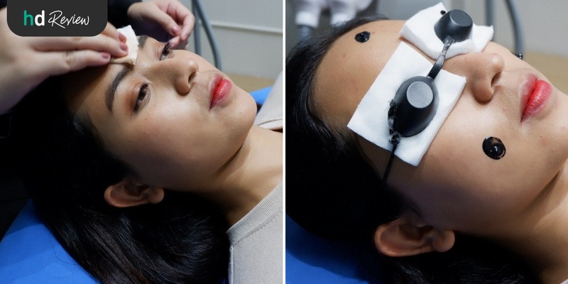 รีวิว Carbon Peel Laser ฟื้นฟูผิว กระชับรูขุมขน ฝ้ากระ ที่ Divine Aesthetic Clinic