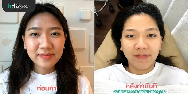 ผลลัพธ์หลังใช้บริการ Carbon Peel Laser ผลัดเซลล์หน้าใส ที่ Punnisa Clinic