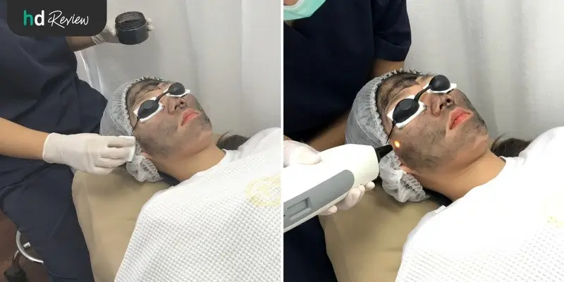 ขั้นตอนการทำ Carbon Peel Laser ผลัดเซลล์หน้าใส ที่ Punnisa Clinic