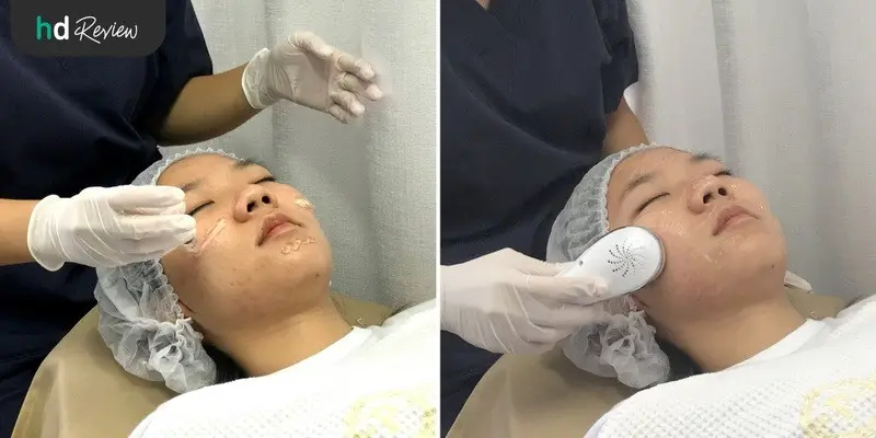 ขั้นตอนการทำ Carbon Peel Laser ผลัดเซลล์หน้าใส ที่ Punnisa Clinic