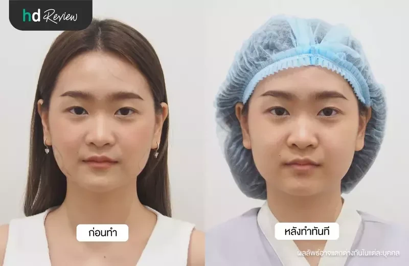 ภาพเปรียบเทียบก่อนทำและหลังตัดไขมันกระพุ้งแก้มทันที