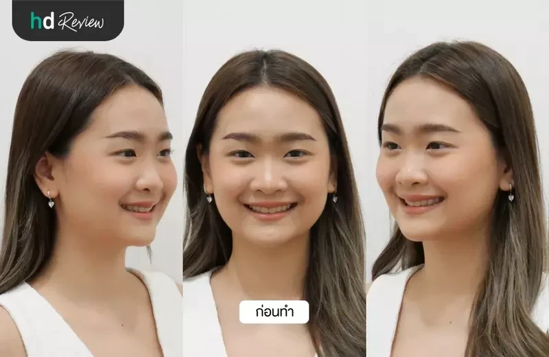 ภาพก่อนตัดไขมันกระพุ้งแก้ม ที่ HERS Clinic