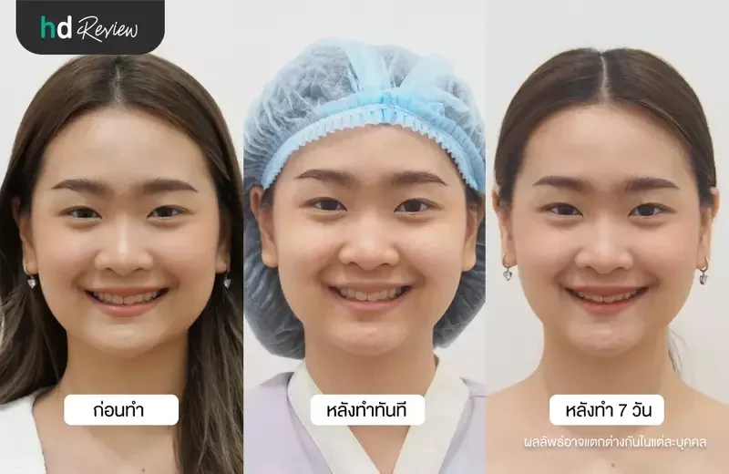 ภาพเปรียบเทียบก่อนทำ หลังทำทันที และหลังตัดไขมันกระพุ้งแก้มครบ 7 วัน
