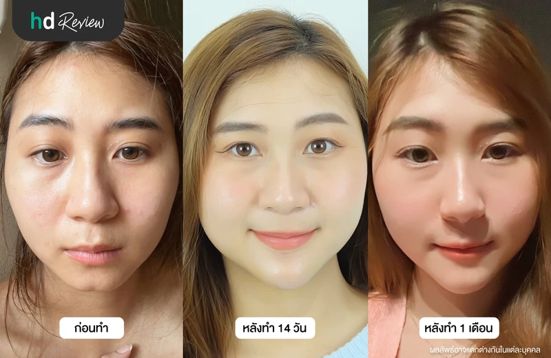 ภาพเปรียบเทียบก่อนเสริมคาง หลังเสริม 14 วัน และหลังเสริม 1 เดือน