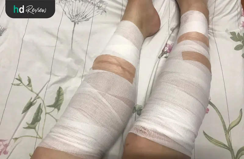 รีวิว กำจัดขนหน้าแข้งด้วยคลื่นความถี่วิทยุ ที่โรงพยาบาลยันฮี