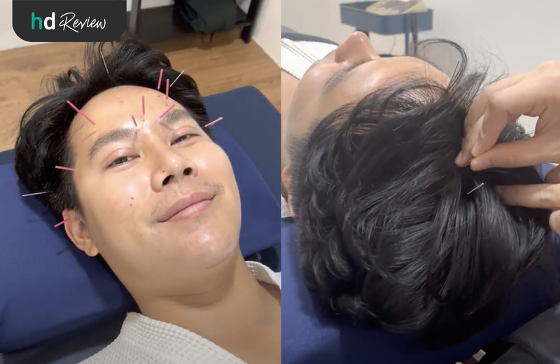 ขั้นตอนการฝังเข็ม