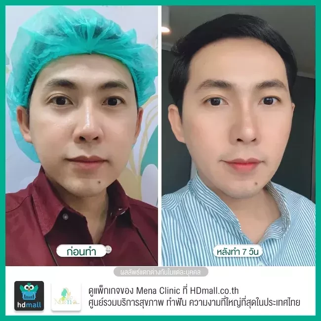 Before After รีวิว ตัดไขมันกระพุ้งแก้ม ที่ Mena Clinic