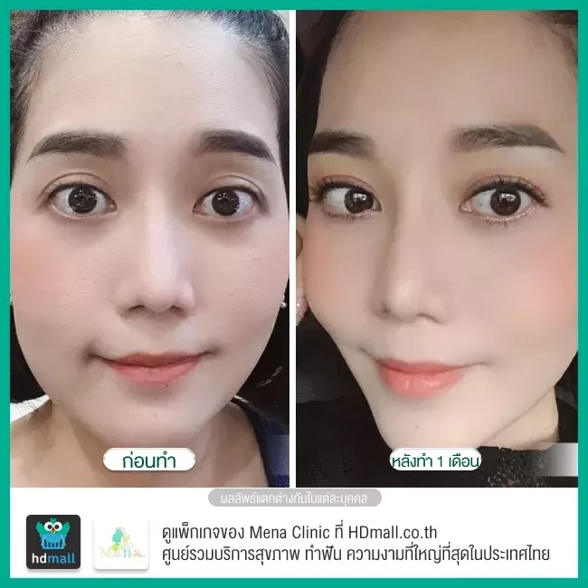Before After รีวิว ตัดไขมันกระพุ้งแก้ม ที่ Mena Clinic