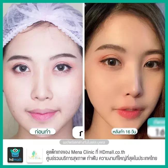 Before After รีวิว ตัดไขมันกระพุ้งแก้ม ที่ Mena Clinic