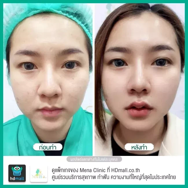 Before After รีวิว ตัดไขมันกระพุ้งแก้ม ที่ Mena Clinic