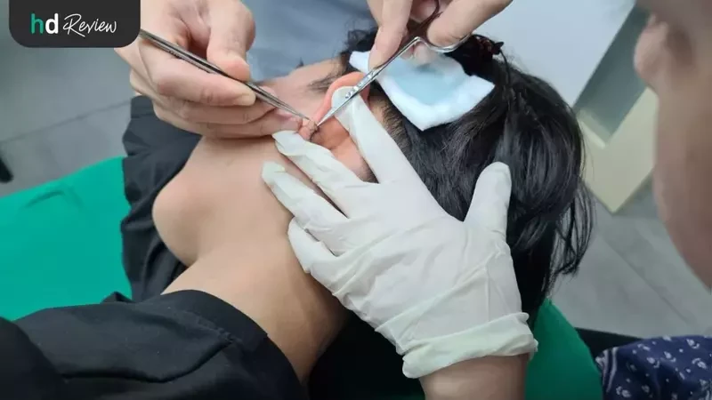 รีวิว ตัดก้อนคีลอยด์ ที่ GROW&GLOW Clinic