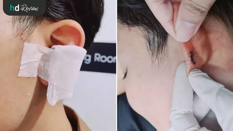 รีวิว ตัดก้อนคีลอยด์ ที่ GROW&GLOW Clinic