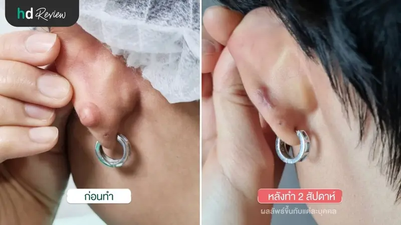 ผลลัพธ์หลังจากตัดก้อนคีลอยด์ ที่ GROW&GLOW Clinic