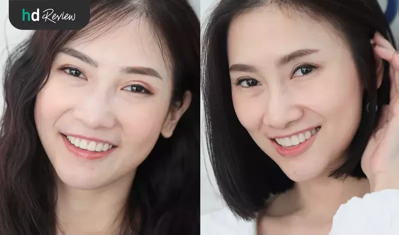 content review cutting gum with laser at grace dental clinic by cherry apple 10