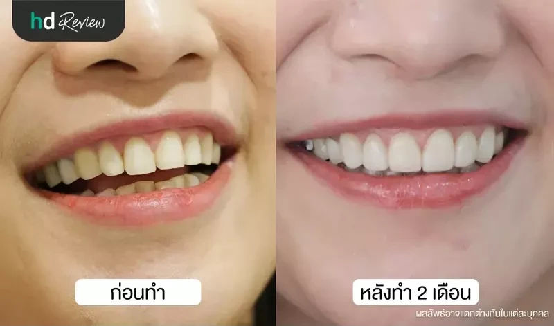 content review cutting gum with laser at grace dental clinic by cherry apple 8