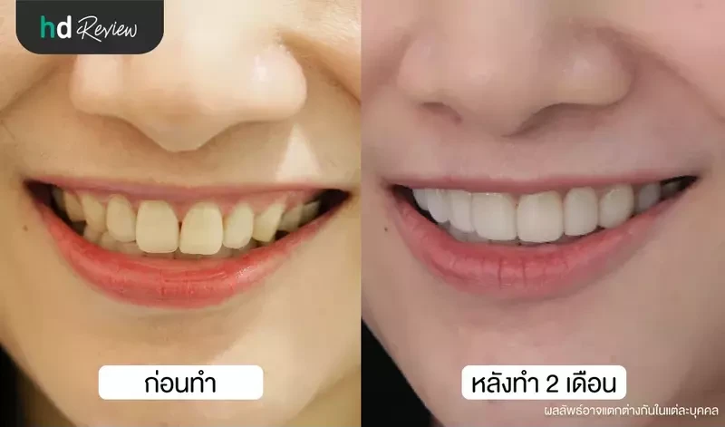 content review cutting gum with laser at grace dental clinic by cherry apple 9