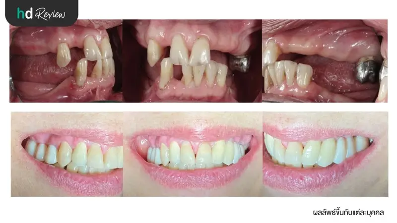 ภาพเปรียบเทียบ ก่อนทำรากฟันเทียม และหลังทำรากฟันเทียม