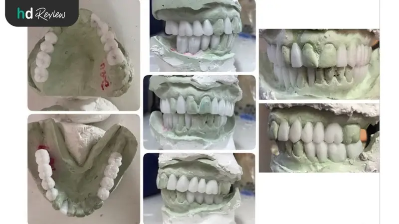อุปกรณ์หลังพิมพ์ฟันเพื่อทำรากเทียม ของ The Orange Dental Clinic