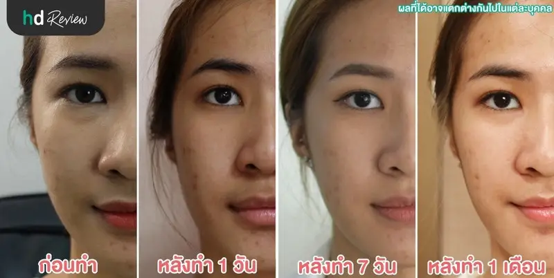 ภาพก่อนทำการฉีดลดรอยสิว หลังทำ1วัน หลังทำ7วัน และหลังทำ1เดือน