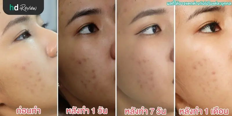 ภาพก่อนทำการฉีดลดรอยสิว หลังทำ1วัน หลังทำ7วัน และหลังทำ1เดือน