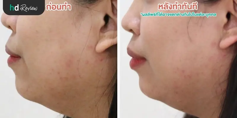 ฟื้นฟูผิวคล้ำแดดจากทะเลด้วยโปรแกรม Dermasport ที่ BB Clinic 5 รีวิวนวดหน้ากับโปรแกรม Dermasport สำหรับผิวเสียมากหลังออกแดด ที่ BB Clinic สาขาทองหล่อ