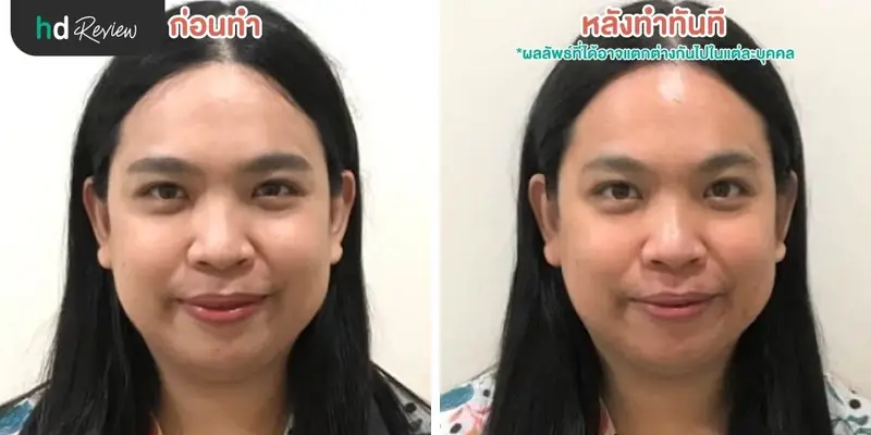 ฟื้นฟูผิวคล้ำแดดจากทะเลด้วยโปรแกรม Dermasport ที่ BB Clinic 7 รีวิวนวดหน้ากับโปรแกรม Dermasport สำหรับผิวเสียมากหลังออกแดด ที่ BB Clinic สาขาทองหล่อ