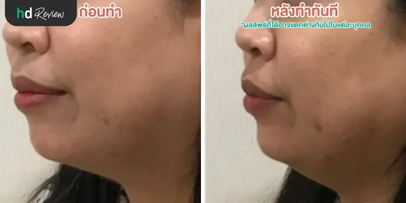 ฟื้นฟูผิวคล้ำแดดจากทะเลด้วยโปรแกรม Dermasport ที่ BB Clinic 8 รีวิวนวดหน้ากับโปรแกรม Dermasport สำหรับผิวเสียมากหลังออกแดด ที่ BB Clinic สาขาทองหล่อ