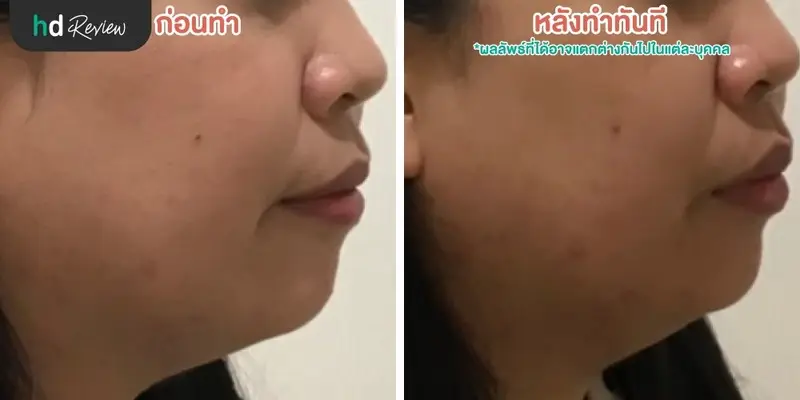 ฟื้นฟูผิวคล้ำแดดจากทะเลด้วยโปรแกรม Dermasport ที่ BB Clinic 9 รีวิวนวดหน้ากับโปรแกรม Dermasport สำหรับผิวเสียมากหลังออกแดด ที่ BB Clinic สาขาทองหล่อ
