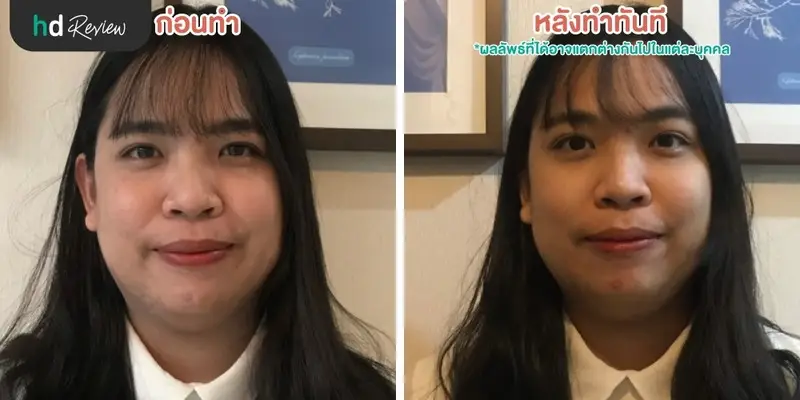 ฟื้นฟูผิวคล้ำแดดจากทะเลด้วยโปรแกรม Dermasport ที่ BB Clinic 10 รีวิวนวดหน้ากับโปรแกรม Dermasport สำหรับผิวเสียมากหลังออกแดด ที่ BB Clinic สาขาทองหล่อ