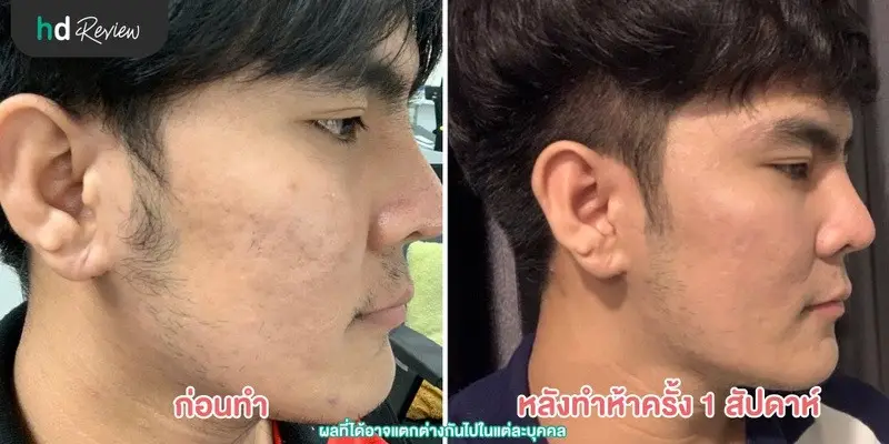 ภาพเปรียบเทียบก่อนทำกับหลังทำ 5 ครั้ง 1 สัปดาห์