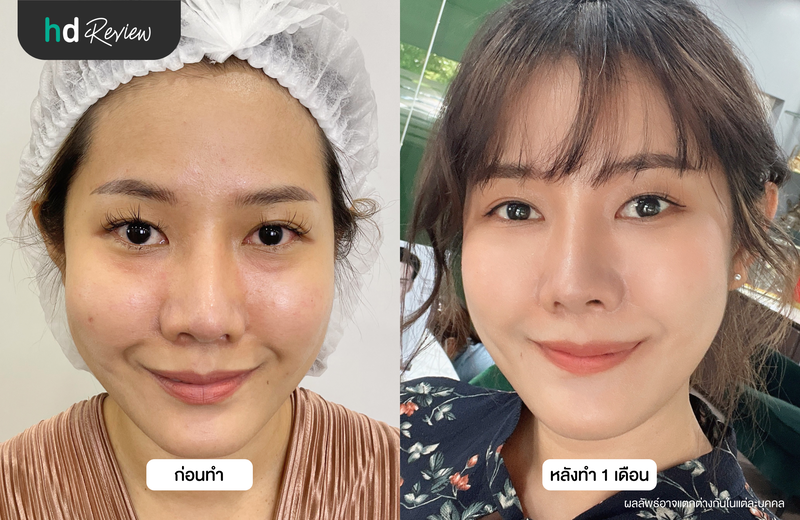 ผลลัพธ์หลังทำ Thermage Eyes