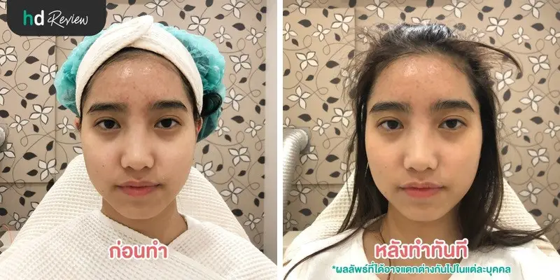 ภาพเปรียบเทียบก่อนทำกับหลังทำ