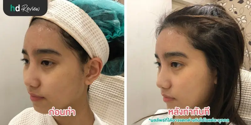 ภาพเปรียบเทียบก่อนทำกับหลังทำ