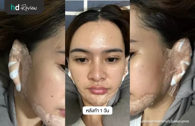 หลังศัลยกรรมแก้ไขหูกาง 1 วัน