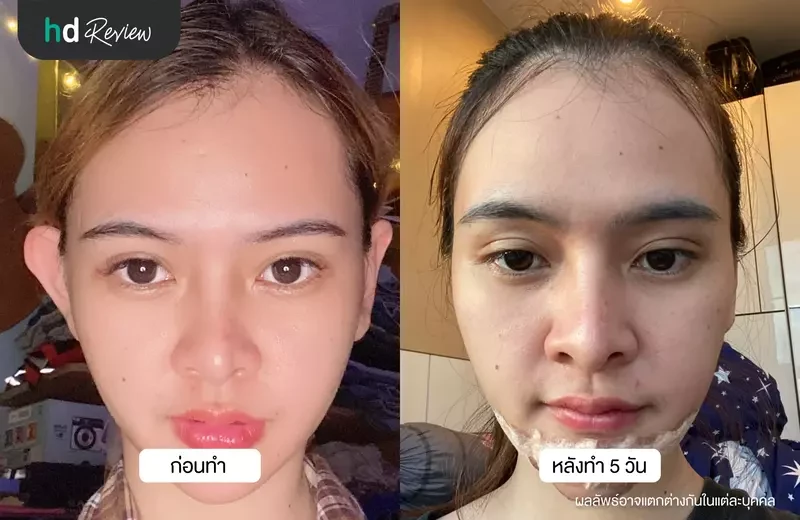 ภาพเปรียบเทียบก่อนและหลังศัลยกรรมแก้ไขหูกาง 5 วัน