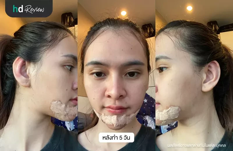 หลังศัลยกรรมแก้ไขหูกาง 5 วัน