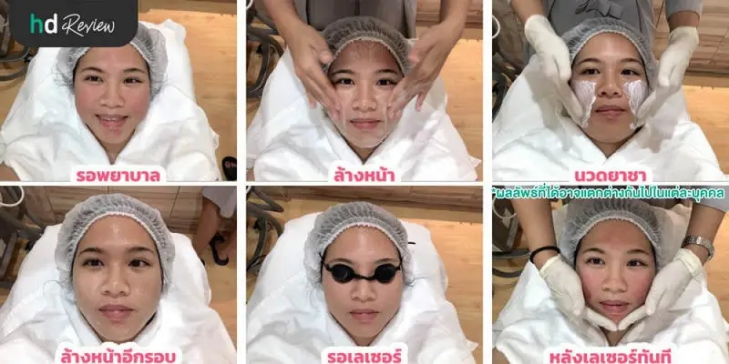รีวิวการทำ E-Matrix ครั้งแรก ที่ SC Clinic 8 ขั้นตอนการทำ E-Matrix ครั้งแรก ที่ SC Skinclub Clinic