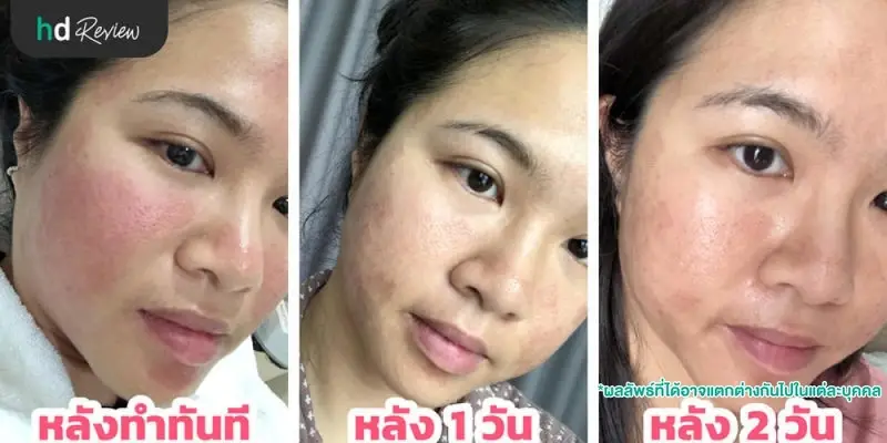 รีวิวการทำ E-Matrix ครั้งแรก ที่ SC Clinic 9 เปรียบเทียบผลลัพธ์หลังทำ E-Matrix ทันที หลังทำ 1 วัน และหลังทำ 2 วัน