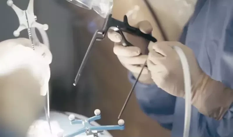 ภาพตัวอย่าง การผ่าตัดด้วยกล้อง Endoscope