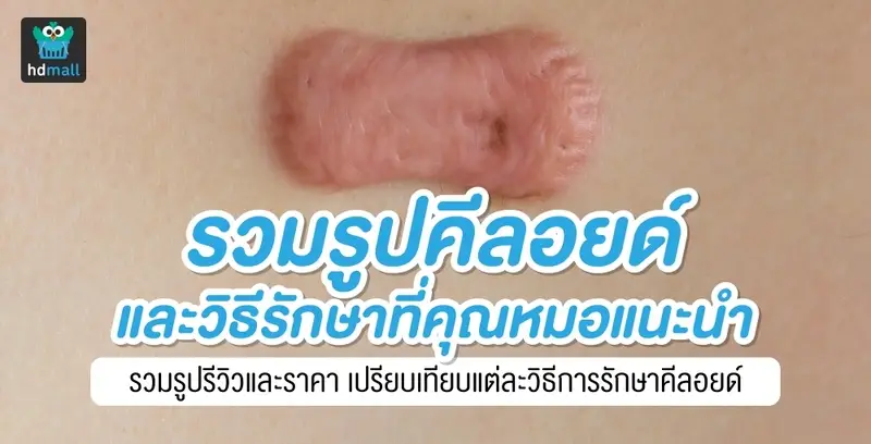 รวมรูปรีวิว รักษาคีลอยด์ยังไงดีที่คุณหมอแนะนำ?