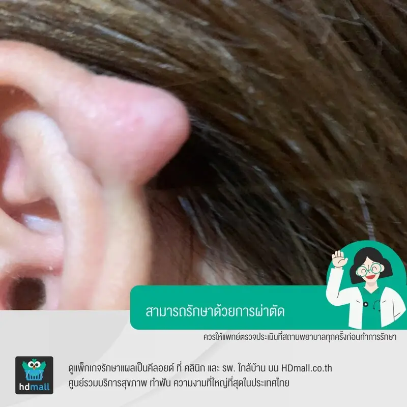 การผ่าตัดแผลเป็นคีลอยด์