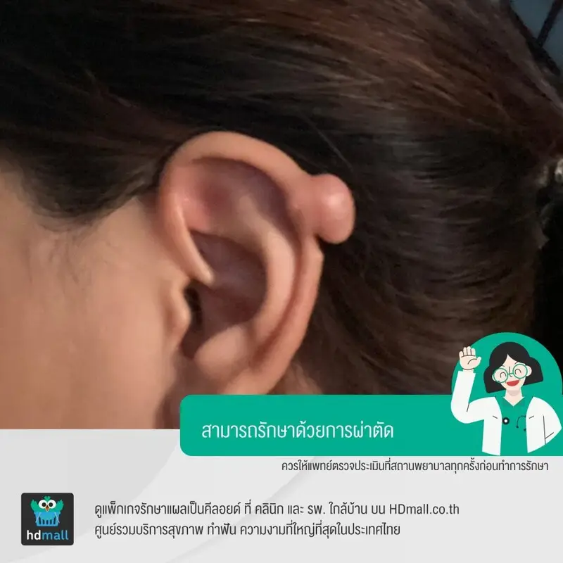 การผ่าตัดแผลเป็นคีลอยด์