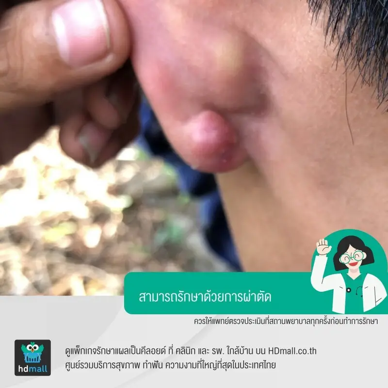 การผ่าตัดแผลเป็นคีลอยด์