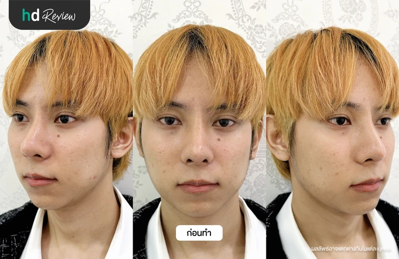 ภาพก่อนฉีดฟื้นฟูใต้ตาคล้ำ Eye Stem