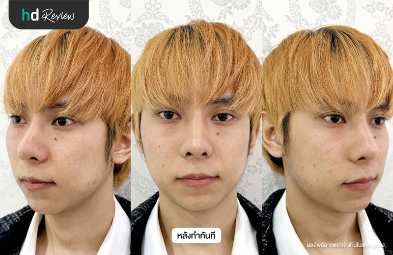 ภาพหลังฉีดฟื้นฟูใต้ตาคล้ำ Eye Stem ทันที