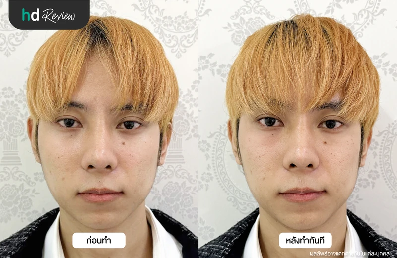 ภาพเปรียบเทียบก่อนและหลังฉีดฟื้นฟูใต้ตาคล้ำ Eye Stem